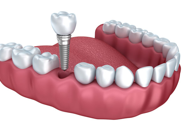 Dental Implant in Mississauga