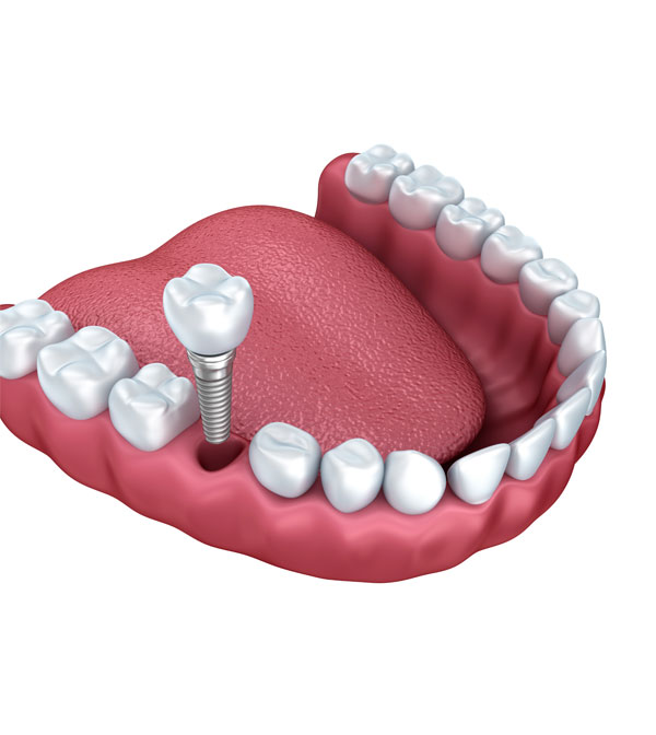 Dental implant in mississauga ontario image