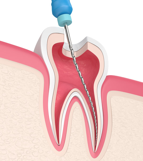 Root Canal with seal in mississauga image
